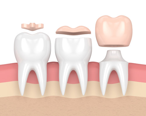 Inlays, onlays et inlays-cores : comment choisir ? - ADP Assurances