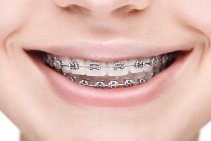 Prise en charge des soins d’orthodontie : assurance maladie et mutuelle